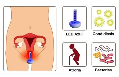 tratamiento para candidiasis