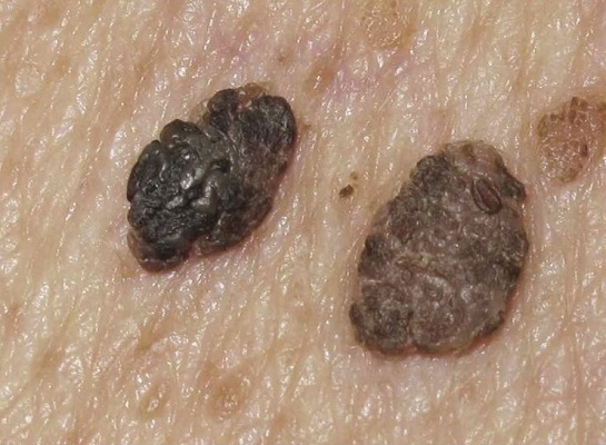 Queratosis Seborreica