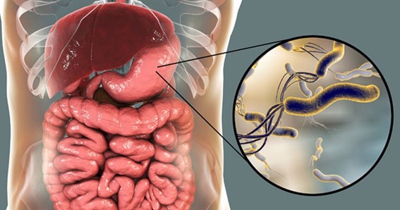 Gastritis