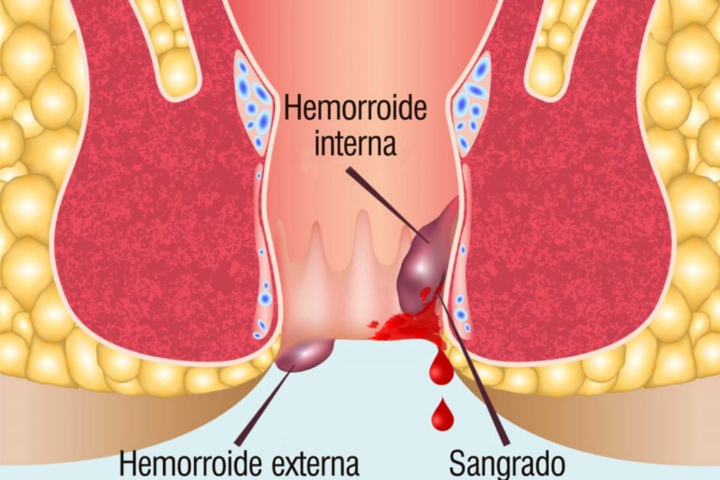 hemorroides