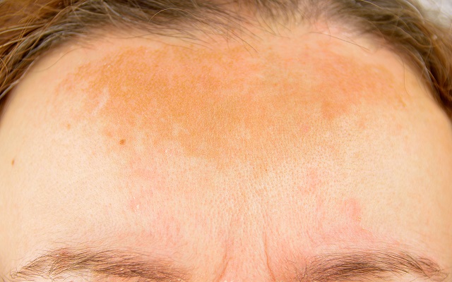 tratamiento para el melasma