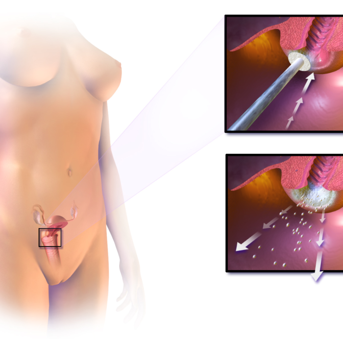 Crioterapia Cervical