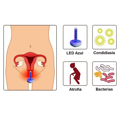 fotomodulación vaginal. tratamiento led para candidiasis